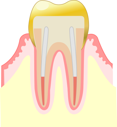 インレー＆クラウンとは？